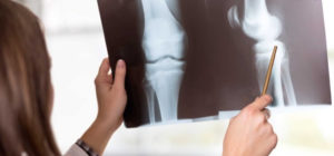 Fraturas no Joelho - Diagnóstico e Tratamento