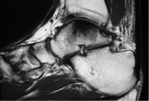 Osteoartrite do Tornozelo