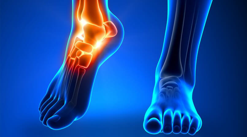 Osteoartrite do Tornozelo