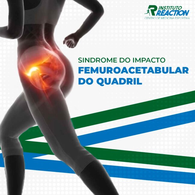 Síndrome do impacto femoroacetabular do quadril.