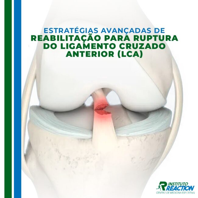 Estratégias Avançadas de Reabilitação para Ruptura do Ligamento Cruzado Anterior (LCA)